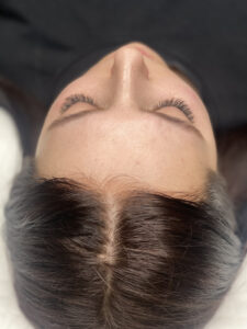 szkolenie mezoterapia mikroigłowa